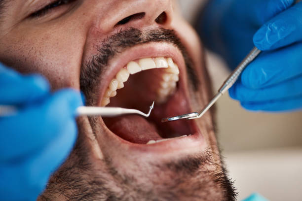 Best Emergency Dental Care for Broken or Chipped Teeth in South Ack, NY